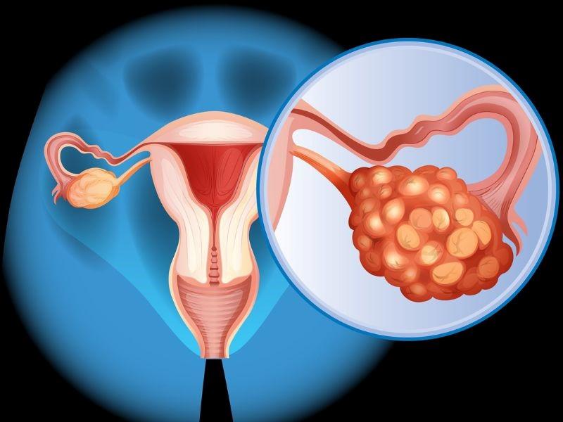 Ung thư buồng trứng giai đoạn 4 và những điều bạn cần biết
