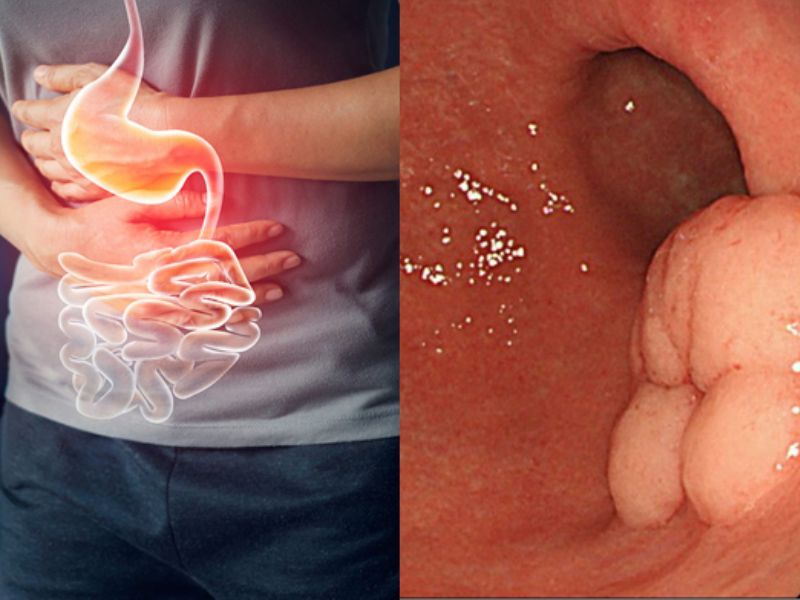 Ung thư dạ dày giai đoạn 3: Triệu chứng, cách chẩn đoán và phương pháp điều trị