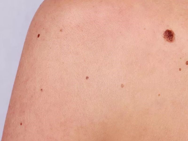 Ung thư da sống được bao lâu?