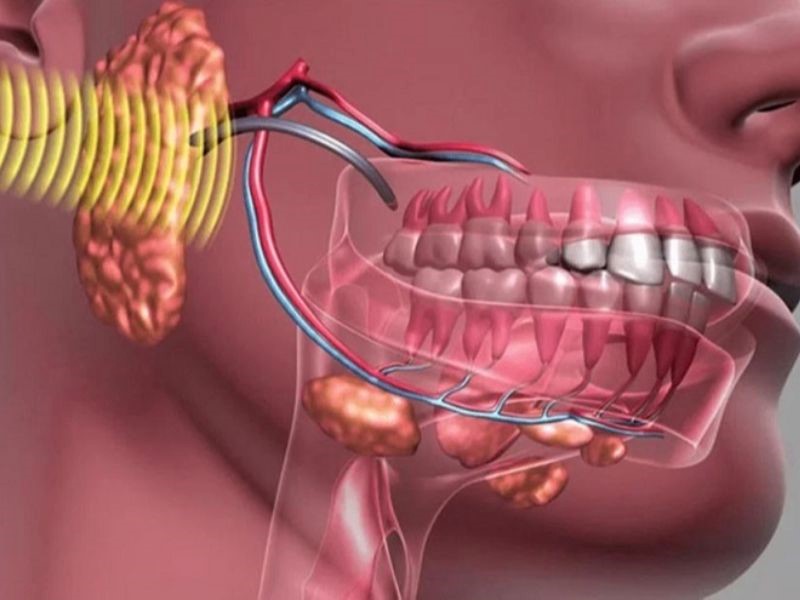 Giải đáp: Ung thư xương hàm có chữa được không?